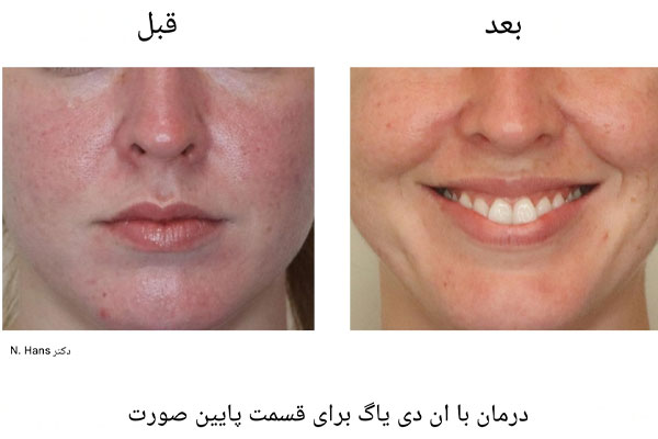 ان-دی-یاگ دستگاه لیزر اندی یاگ