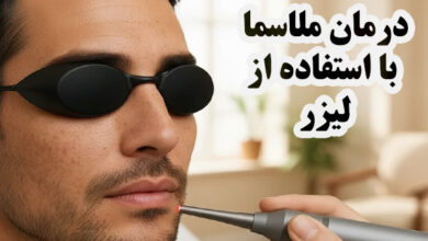 درمان ملاسما با لیزر