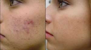 آیا بیماری ملاسمای صورت را می توان با لیزر درمان کرد؟