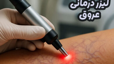 لیزر عروق