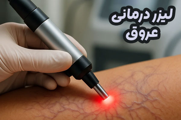 لیزر عروق