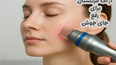 آر اف فرکشنال برای رفع جای جوش