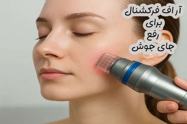 آر اف فرکشنال برای رفع جای جوش