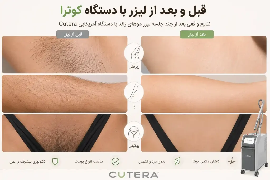  قبل و بعد از لیزر با دستگاه کوترا 