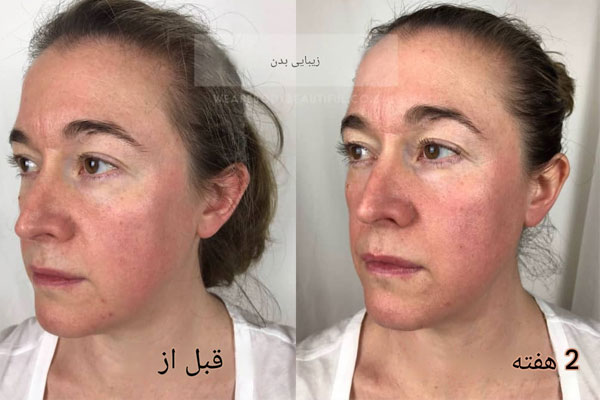 لیزر-خانگی-تریا-پریسیژن