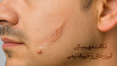 لیزر جای زخم