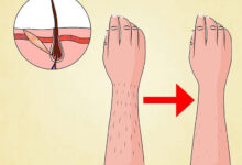 تاثیر لیزر بر فولیکول های مو